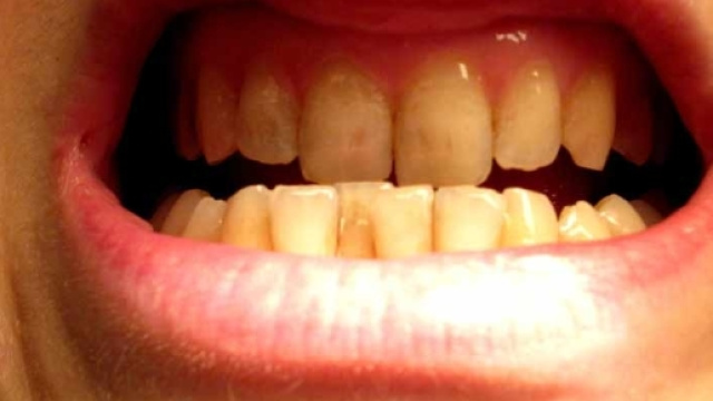 Bruxismo spezza i denti: colpa dello stress?