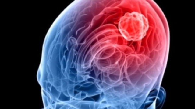 Meningite: sintomi, cause, diagnosi, modalit&agrave; di trasmissione ... - meteoweb.eu