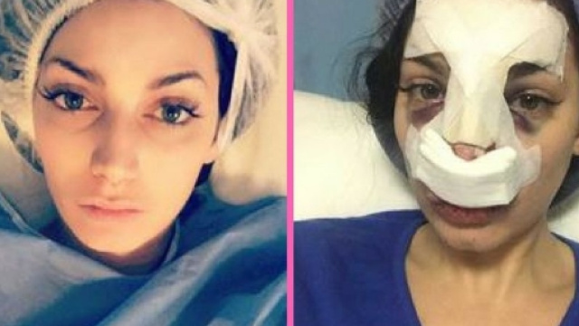Secret Story : Nadège Lacroix s'est fait refaire le nez !
