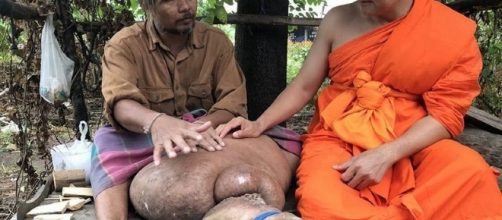 La gamba spaventosa di un 42enne thailandese: Boonthing soffre di linfedema