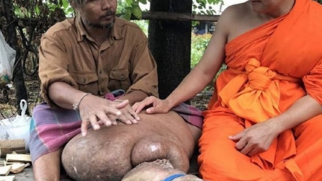 La gamba spaventosa di un 42enne thailandese: Boonthing soffre di linfedema