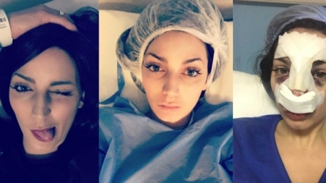 Nadège défigurée après sa rhinoplastie