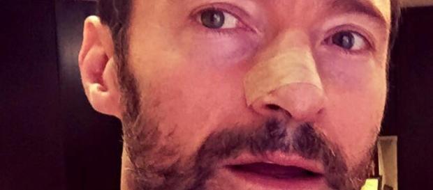 Hugh Jackman mostra su Facebook il suo cancro Hugh Jackman mostra su Facebook il suo cancro