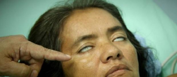Mulher tem as pálpebras paralisadas Mulher tem as pálpebras paralisadas