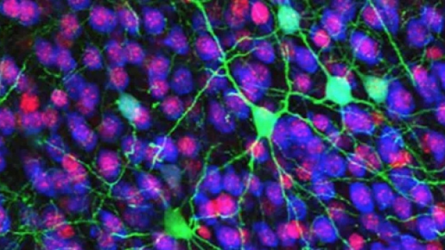 Neuroni anomali nella sindrome di Rett (MacDonald)