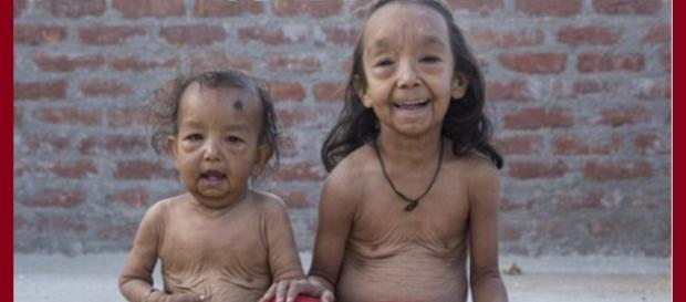Cutis laxia. Foto de'The Daily Post' Cutis laxia. Foto de'The Daily Post'