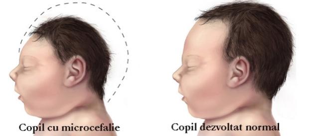 Zika ar putea compromite evoluţia speciei umane Zika ar putea compromite evoluţia speciei umane