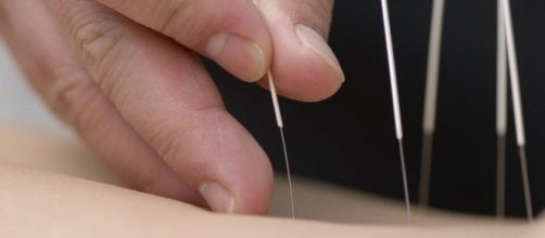 Un agopuntura durante l'applicazione degli aghi