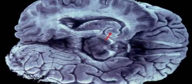 hallucinations show bad relationship in the brain hallucinations show bad relationship in the brain