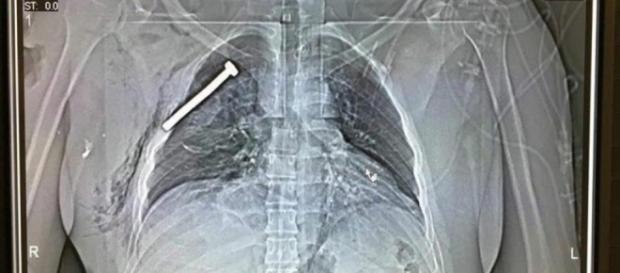 Radiografia di un ferito dopo gli attentati di Bruxelles Radiografia di un ferito dopo gli attentati di Bruxelles