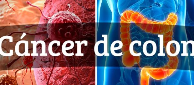 Como prevenir el Cáncer de Colon Como prevenir el Cáncer de Colon
