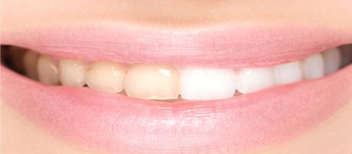 There are several home remedies to whiten teeth/Photo via Freepik.