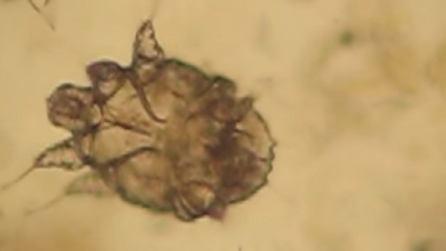 Acaro Sarcoptes Scabei -Il contagio avviene, soprattutto, pelle-pelle, quindi attraverso il contatto