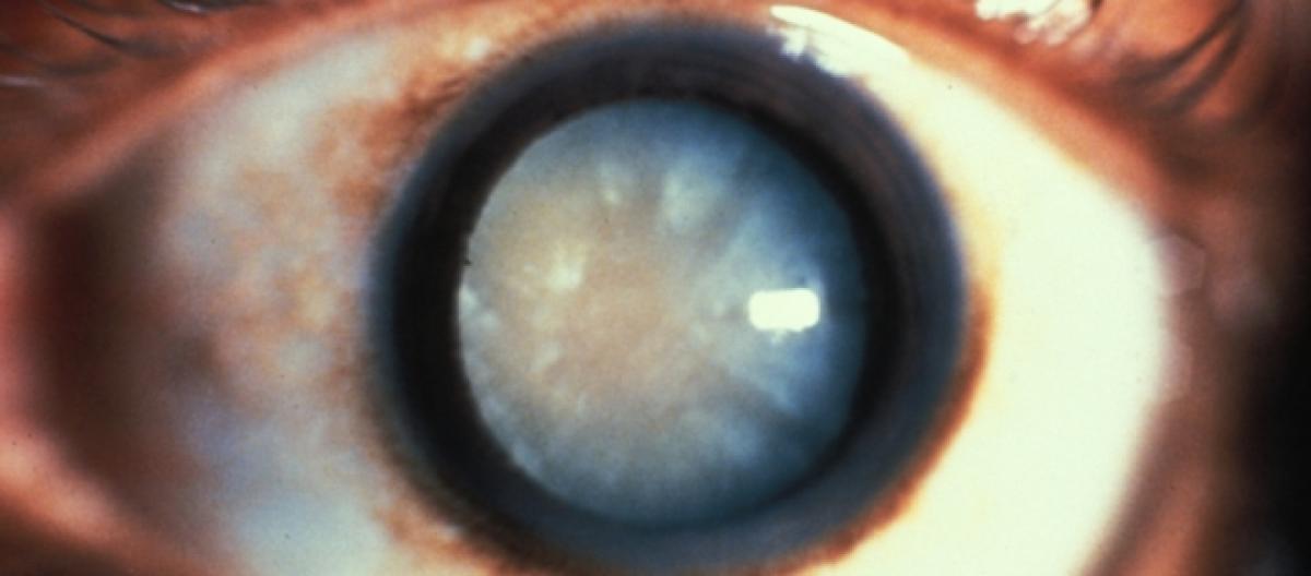 Resultado de imagem para cientistas desenvolvem colirio de derrete catarata do olho