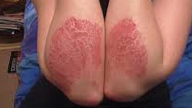 Psoriasi. In USA approvato un nuovo farmaco