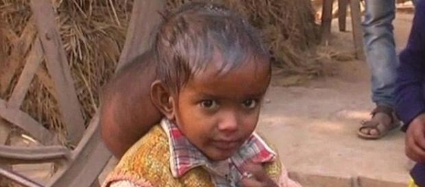 Menina na Índia tinha um tumor do tamanho de uma bola de futebol na cabeça Menina na Índia tinha um tumor do tamanho de uma bola de futebol na cabeça