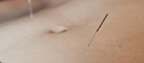 Acupuncture can treat irritable bowel syndrome.