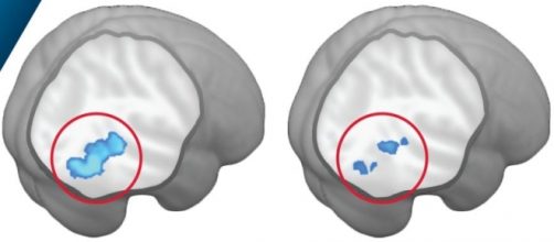 Il circuito della percezione sociale nei bimbi autistici (destra) e non (sinistra) (Credit: Washington University)