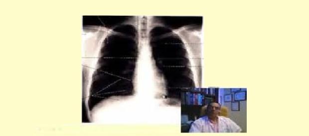 De que trata la embolia pulmonar De que trata la embolia pulmonar
