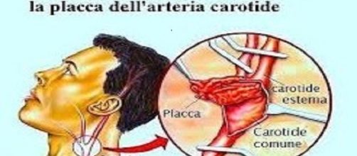 Le arterie e le placche aterosclerotiche