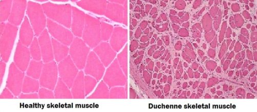 Tessuto muscolare sano (a sinistra) e affetto da distrofia di Duchenne (a destra)