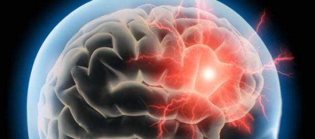 Apesar de ser considerada uma doença leve, a enxaqueca pode comprometer a estrutura cerebral Apesar de ser considerada uma doença leve, a enxaqueca pode comprometer a estrutura cerebral