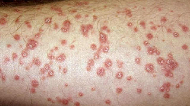 APREMILAST è stato il primo farmaco a somministrazione orale, approvato per il trattamento della psoriasi e dell’artrite psoriasica