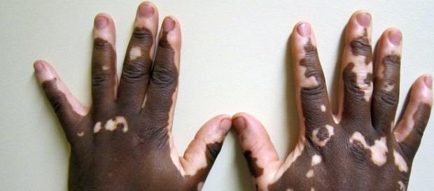 Example of vitiligo on African American hands Example of vitiligo on African American hands