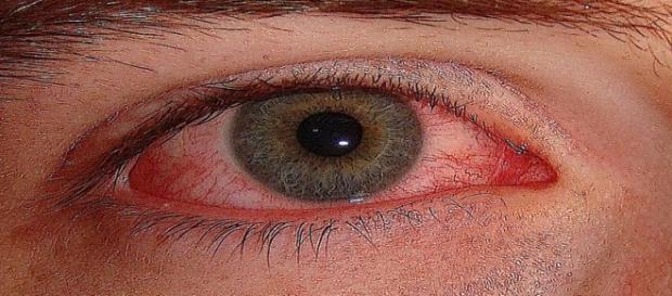 Conjuntivitis por la contaminación Conjuntivitis por la contaminación