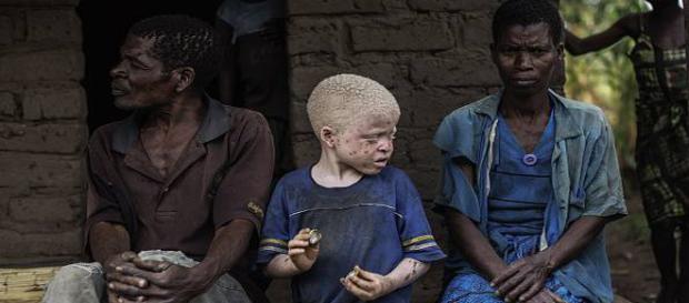 Gli albini in Africa vengono uccisi sistematicamente Gli albini in Africa vengono uccisi sistematicamente