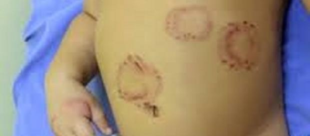 Marcas deixadas no corpo do bebê agredido em Manaus/ AM. Marcas deixadas no corpo do bebê agredido em Manaus/ AM.
