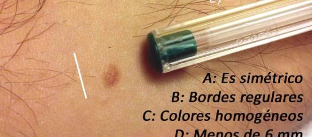 Es mi lunar peligroso? El ABCDE de los nevus - eyrieSalud - eyriesalud.com Es mi lunar peligroso? El ABCDE de los nevus - eyrieSalud - eyriesalud.com