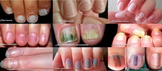 As unhas podem mostrar muito sobre o que passa em nosso organismo se forem bem observadas. As unhas podem mostrar muito sobre o que passa em nosso organismo se forem bem observadas.