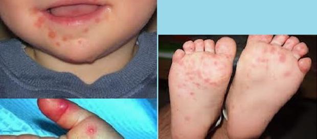Síndrome mão-pé-boca é uma doença viral Síndrome mão-pé-boca é uma doença viral