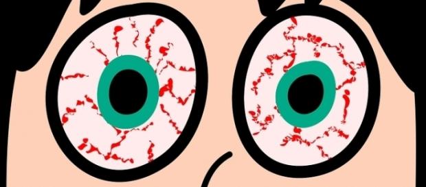 Ojos rojos e irritados debido al insomnio Ojos rojos e irritados debido al insomnio