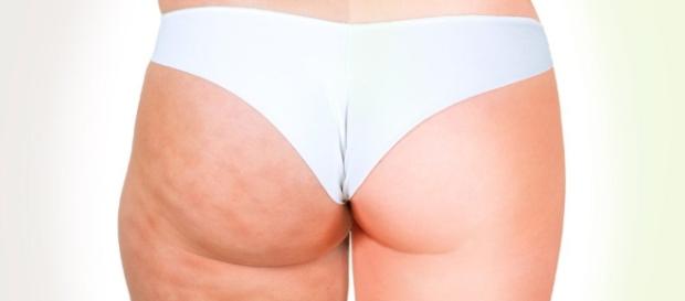 Tipos de celulitis y tratamientos | Celulitispedia - celulitispedia.com Tipos de celulitis y tratamientos | Celulitispedia - celulitispedia.com