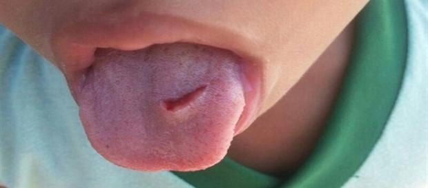 Menino teve a língua cortada pela professora Menino teve a língua cortada pela professora