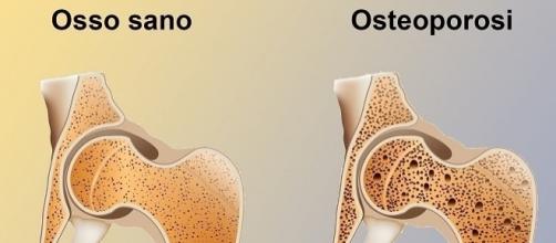 L'osteoporosi colpisce principalmente le donne nell'età post-menopausa. Anche gli uomini non ne sono esenti.