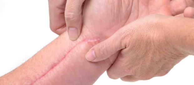 Prevenção e tratamento de cicatrizes Prevenção e tratamento de cicatrizes