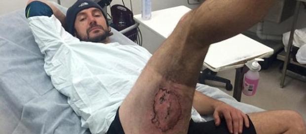 El ciclista australiano con las quemaduras de tercer grado en la pierna derecha El ciclista australiano con las quemaduras de tercer grado en la pierna derecha