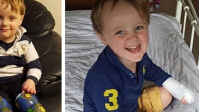 Reuben, il bimbo di tre anni amputato delle gambe per errore medico