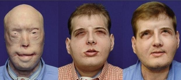 Patrick Hardison, 42 ani, trăiește ”din nou normal” la un an de la transplantul de față suferit - Foto: NYU Langone Medical Center Patrick Hardison, 42 ani, trăiește ”din nou normal” la un an de la transplantul de față suferit - Foto: NYU Langone Medical Center