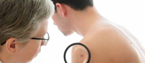 melanoma-benigno-maligno-test-1024×682 | Mediskope - mediskope.com