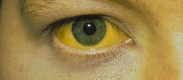 ictericia por bilirrubina alta - SegundoMédico - segundomedico.com ictericia por bilirrubina alta - SegundoMédico - segundomedico.com