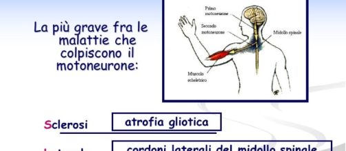 Sclerosi Laterale Amiotrofica un male molto aggressivo