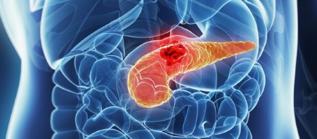 Liposomal Irinotecan Boosts Survival in Pancreatic Cancer - medscape.com Liposomal Irinotecan Boosts Survival in Pancreatic Cancer - medscape.com