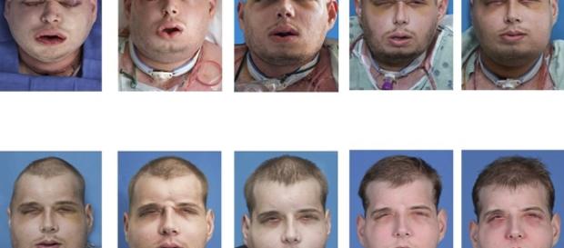 Hombre recibió el trasplante de cara más extenso de la historia ... - emol.com Hombre recibió el trasplante de cara más extenso de la historia ... - emol.com
