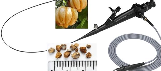 Les calculs sont généralement de taille réduite... La garcinia est un fruit à écorce Les calculs sont généralement de taille réduite... La garcinia est un fruit à écorce