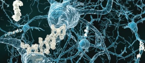 Placche amiloidi attorno ai neuroni