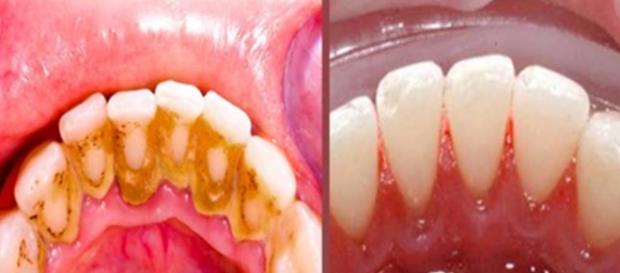 Remédios caseiros para remover a placa bacteriana, confira! Remédios caseiros para remover a placa bacteriana, confira!